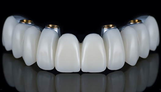 alignement dentaire strasbourg Prothèses sur implants Dentiste Orangerie, Strasbourg | Esthétique & Implant