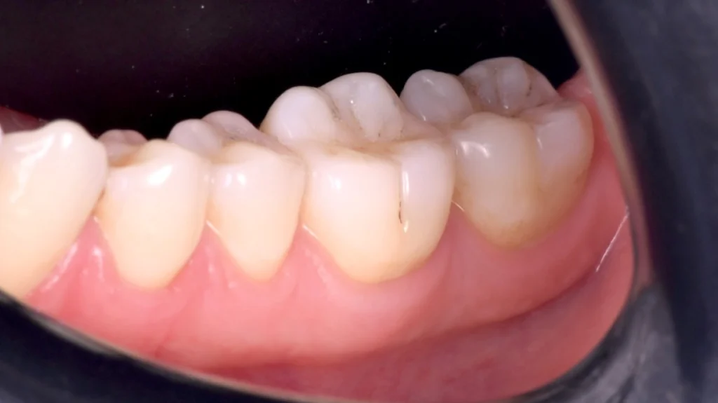 aligneur dentaire strasbourg Greffes de gencives et chirurgie mucogingivale Dentiste Orangerie, Strasbourg | Esthétique & Implant