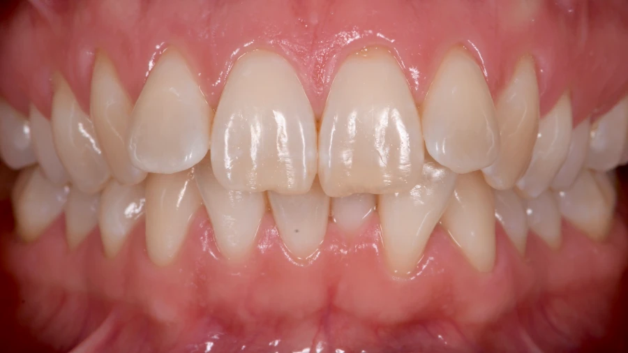 alternatives edentement meilleure option 1 Orthodontie : rééquilibrer et aligner votre sourire Dentiste Orangerie, Strasbourg | Esthétique & Implant