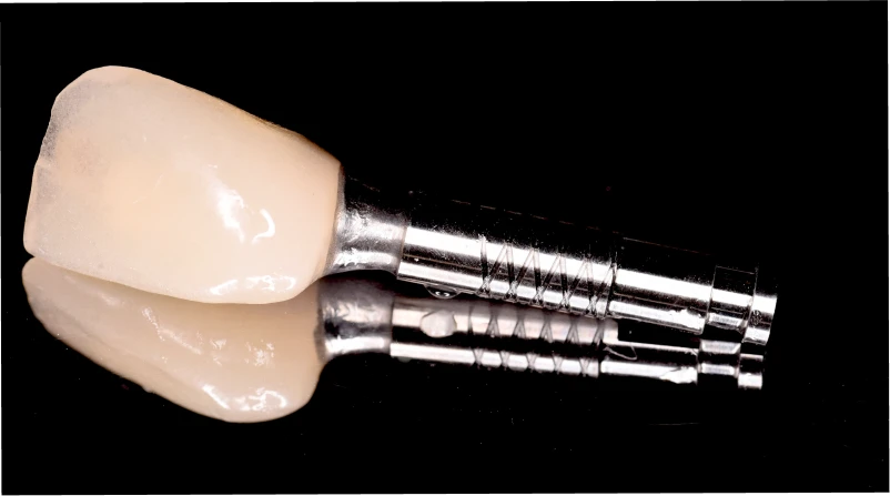 alternatives edentement meilleure option Différentes alternatives à un édentement : trouver la meilleure option Dentiste Orangerie, Strasbourg | Esthétique & Implant