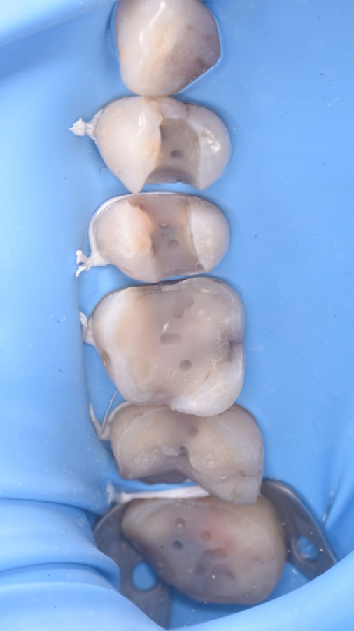 analyse sourire numerique analyse sourire numerique Remplacement d’anciens soins Dentiste Orangerie, Strasbourg | Esthétique & Implant