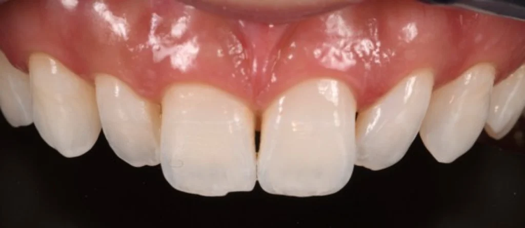 blanchiment ceramique strasbourg blanchiment ceramique strasbourg Concept de gradient thérapeutique Dentiste Orangerie, Strasbourg | Esthétique & Implant