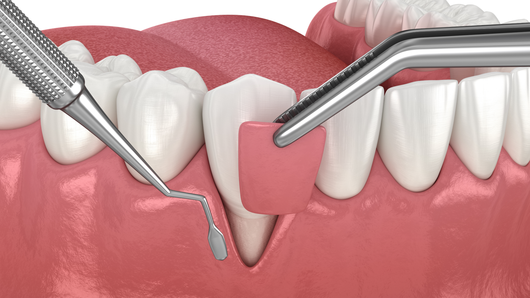blanchiment dentaire pro Greffes de gencives et chirurgie mucogingivale Dentiste Orangerie, Strasbourg | Esthétique & Implant