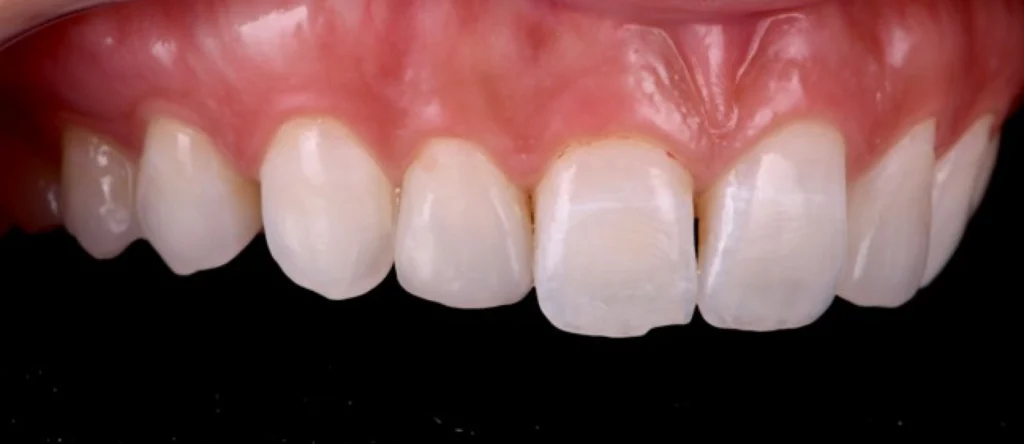 blanchiment facettes strasbourg blanchiment facettes strasbourg Concept de gradient thérapeutique Dentiste Orangerie, Strasbourg | Esthétique & Implant
