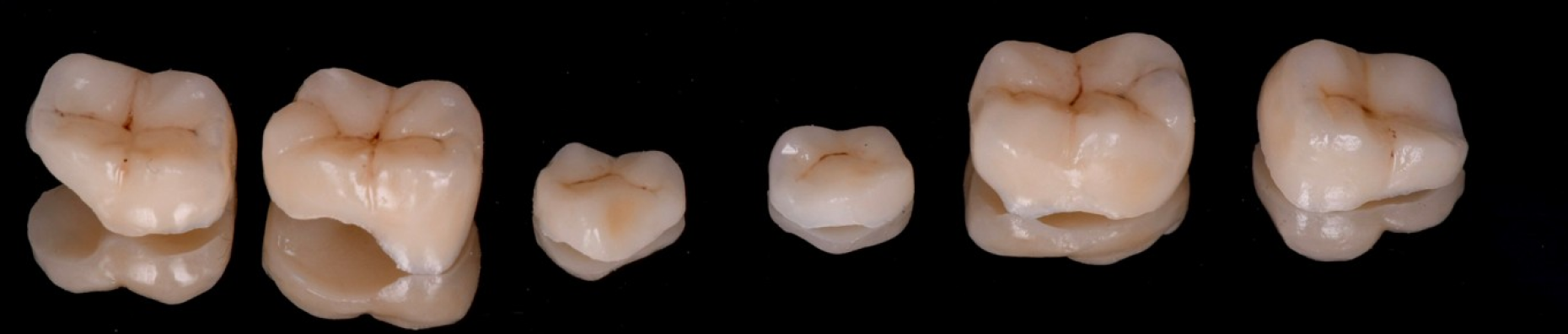 blanchiment naturel strasbourg Inlays / Onlays : préserver et restaurer vos dents Dentiste Orangerie, Strasbourg | Esthétique & Implant