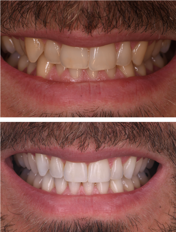 blanchiment professionnel strasbourg Orthodontie : rééquilibrer et aligner votre sourire Dentiste Orangerie, Strasbourg | Esthétique & Implant