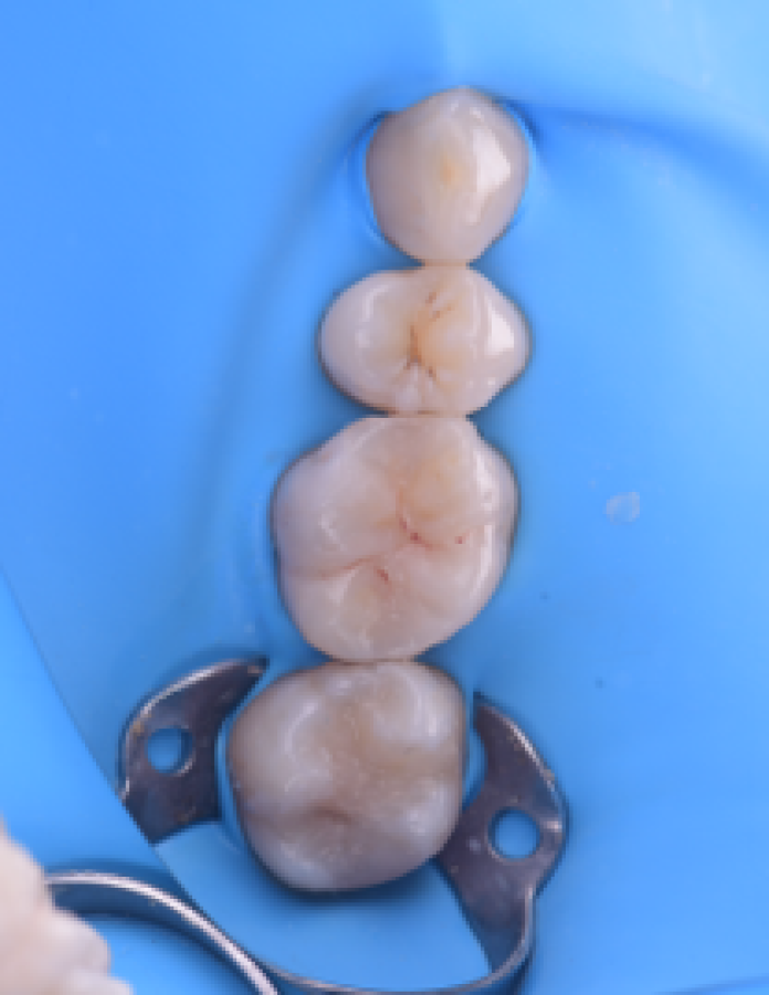blanchiment rapide strasbourg Inlays / Onlays : préserver et restaurer vos dents Dentiste Orangerie, Strasbourg | Esthétique & Implant