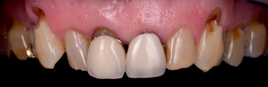 blanchiment sur mesure strasbourg Couronnes dentaires : allier esthétique et durabilité Dentiste Orangerie, Strasbourg | Esthétique & Implant