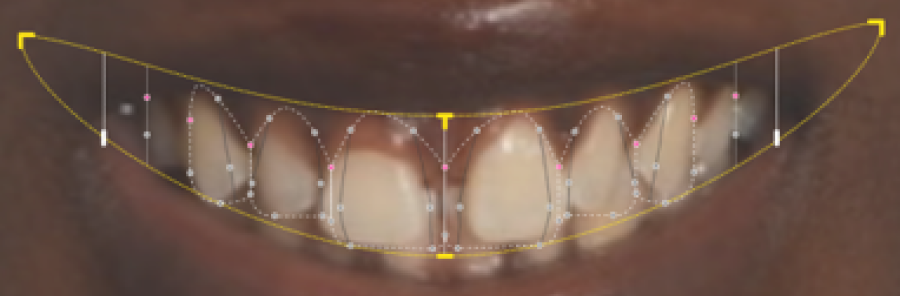 bridge dentaire strasbourg Remodelage esthétique des gencives Dentiste Orangerie, Strasbourg | Esthétique & Implant