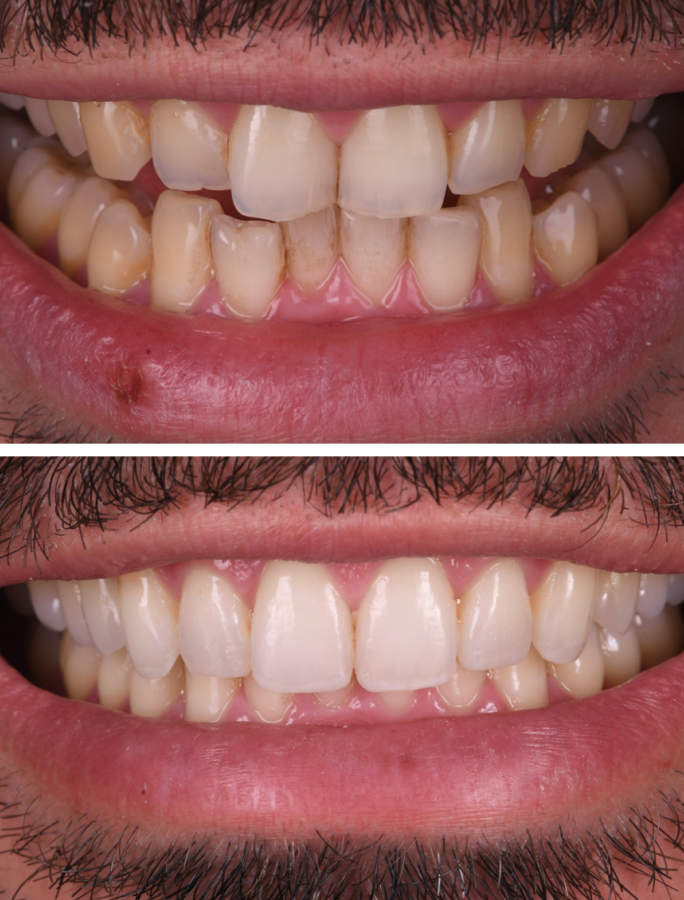 bridge sur implants strasbourg Orthodontie : rééquilibrer et aligner votre sourire Dentiste Orangerie, Strasbourg | Esthétique & Implant