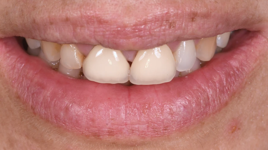 bridges dentaires Couronnes dentaires : allier esthétique et durabilité Dentiste Orangerie, Strasbourg | Esthétique & Implant
