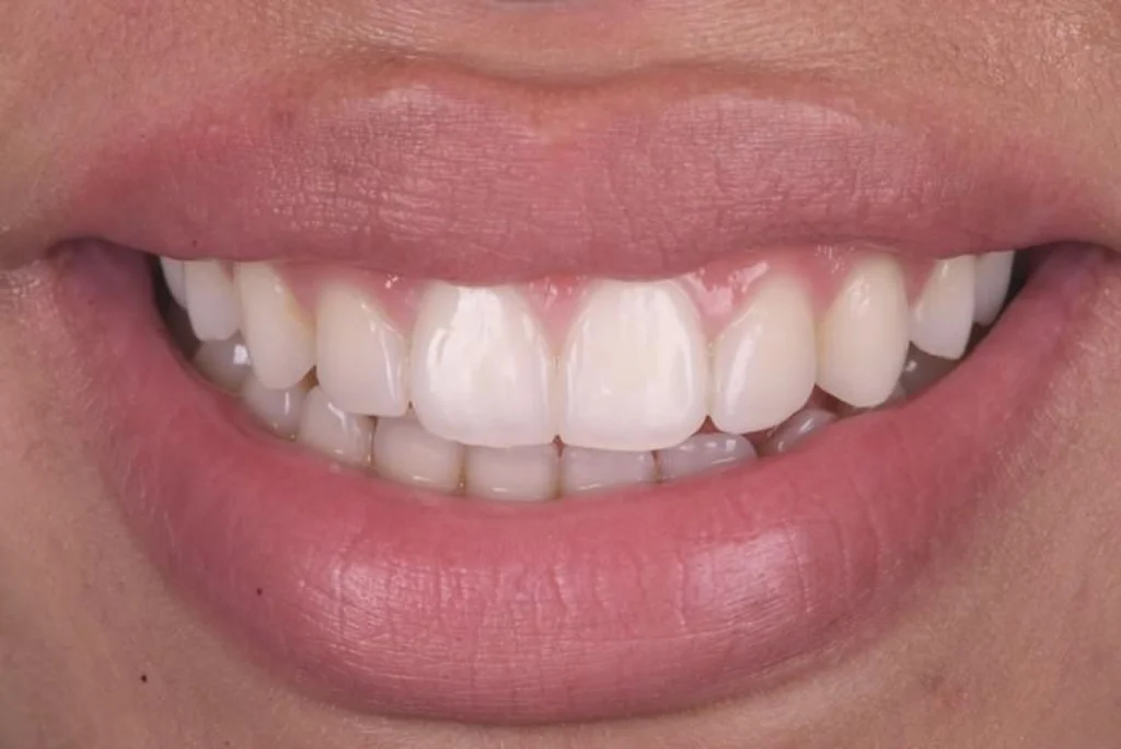 cabinet aesthetic dentistry facettes cabinet aesthetic dentistry facettes Concept de gradient thérapeutique Dentiste Orangerie, Strasbourg | Esthétique & Implant
