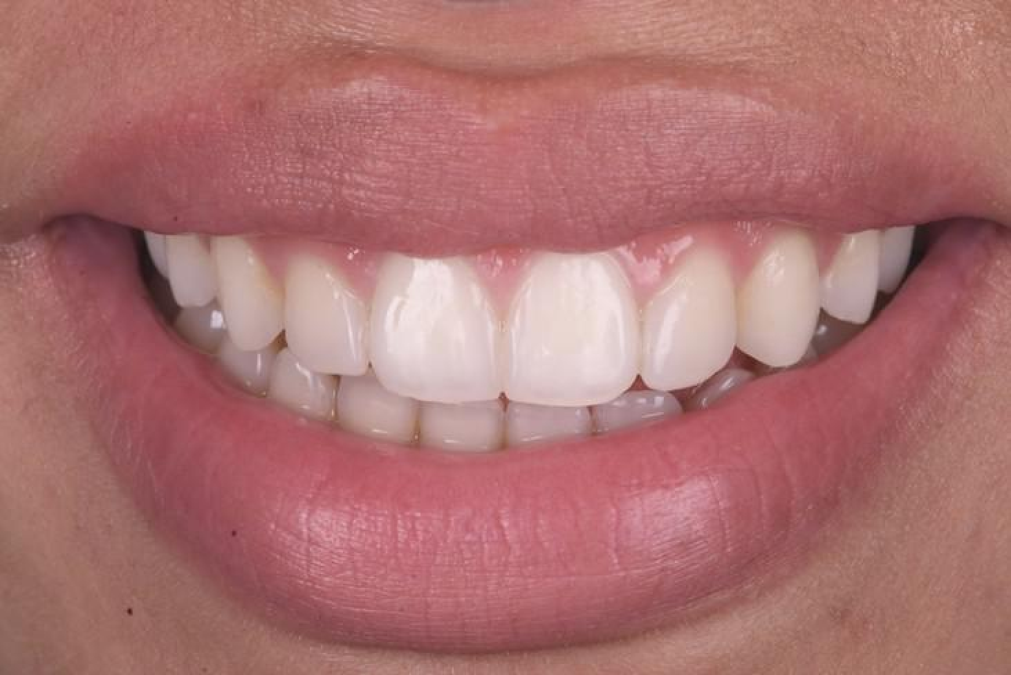 cabinet aesthetic dentistry facettes Concept de gradient thérapeutique Dentiste Orangerie, Strasbourg | Esthétique & Implant