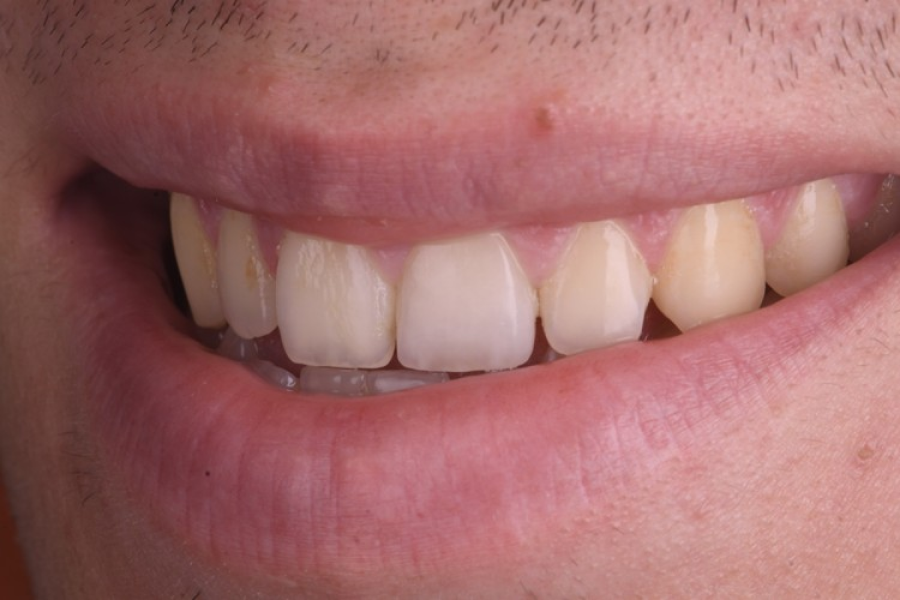 cabinet aesthetic dentistry strasbourg cabinet aesthetic dentistry strasbourg Traitement des fractures Dentiste Orangerie, Strasbourg | Esthétique & Implant