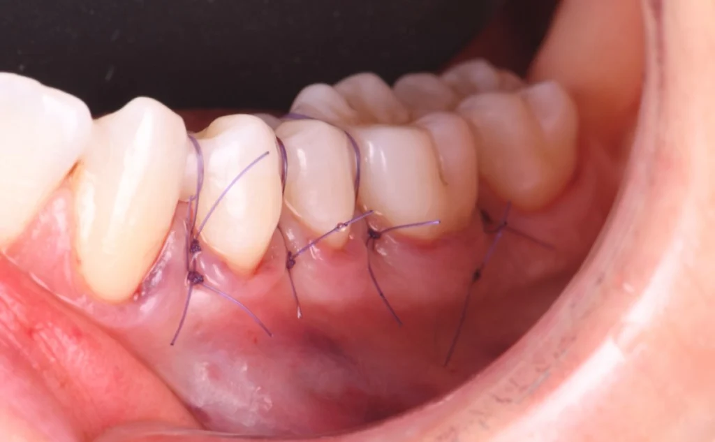 cabinet esthetique strasbourg Greffes de gencives et chirurgie mucogingivale Dentiste Orangerie, Strasbourg | Esthétique & Implant