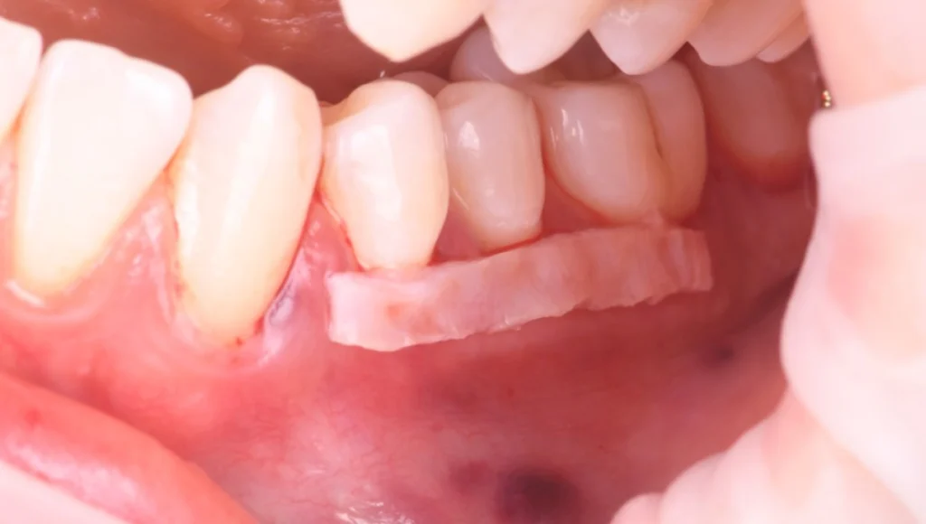 cabinet implantaire strasbourg Greffes de gencives et chirurgie mucogingivale Dentiste Orangerie, Strasbourg | Esthétique & Implant