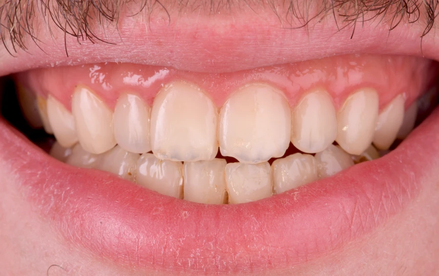 cas edente complet solutions fixes cas edente complet solutions fixes Gestion des caries : préserver vos dents avant tout Dentiste Orangerie, Strasbourg | Esthétique & Implant