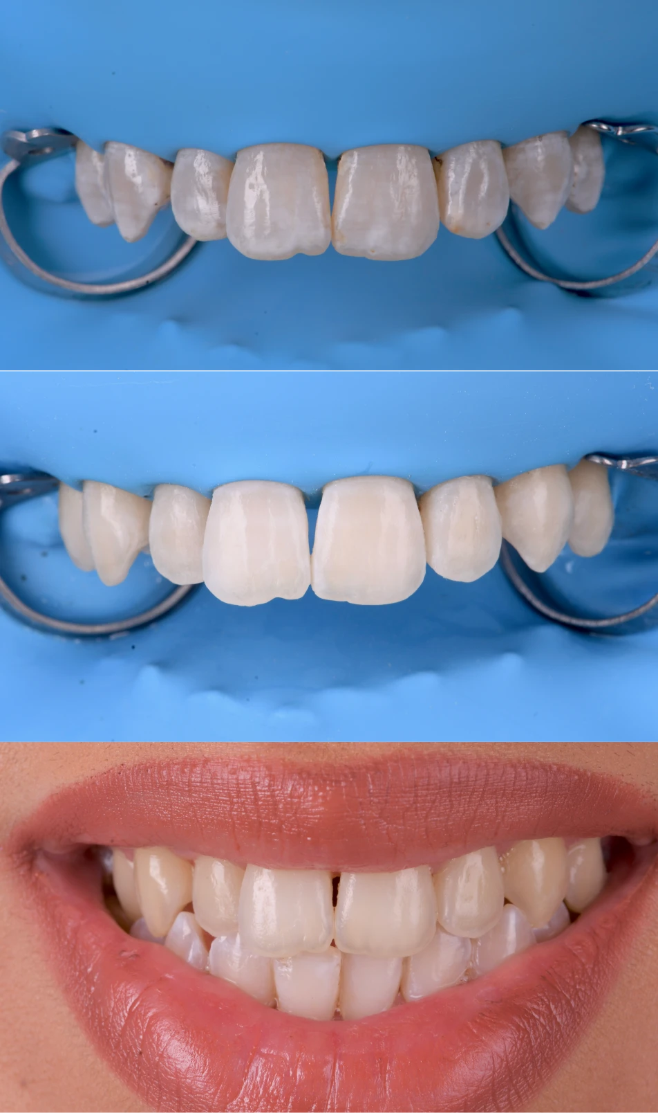 cas traitement taches dentaires strasbourg 1 Traitement des tâches dentaires : un sourire magnifié Dentiste Orangerie, Strasbourg | Esthétique & Implant