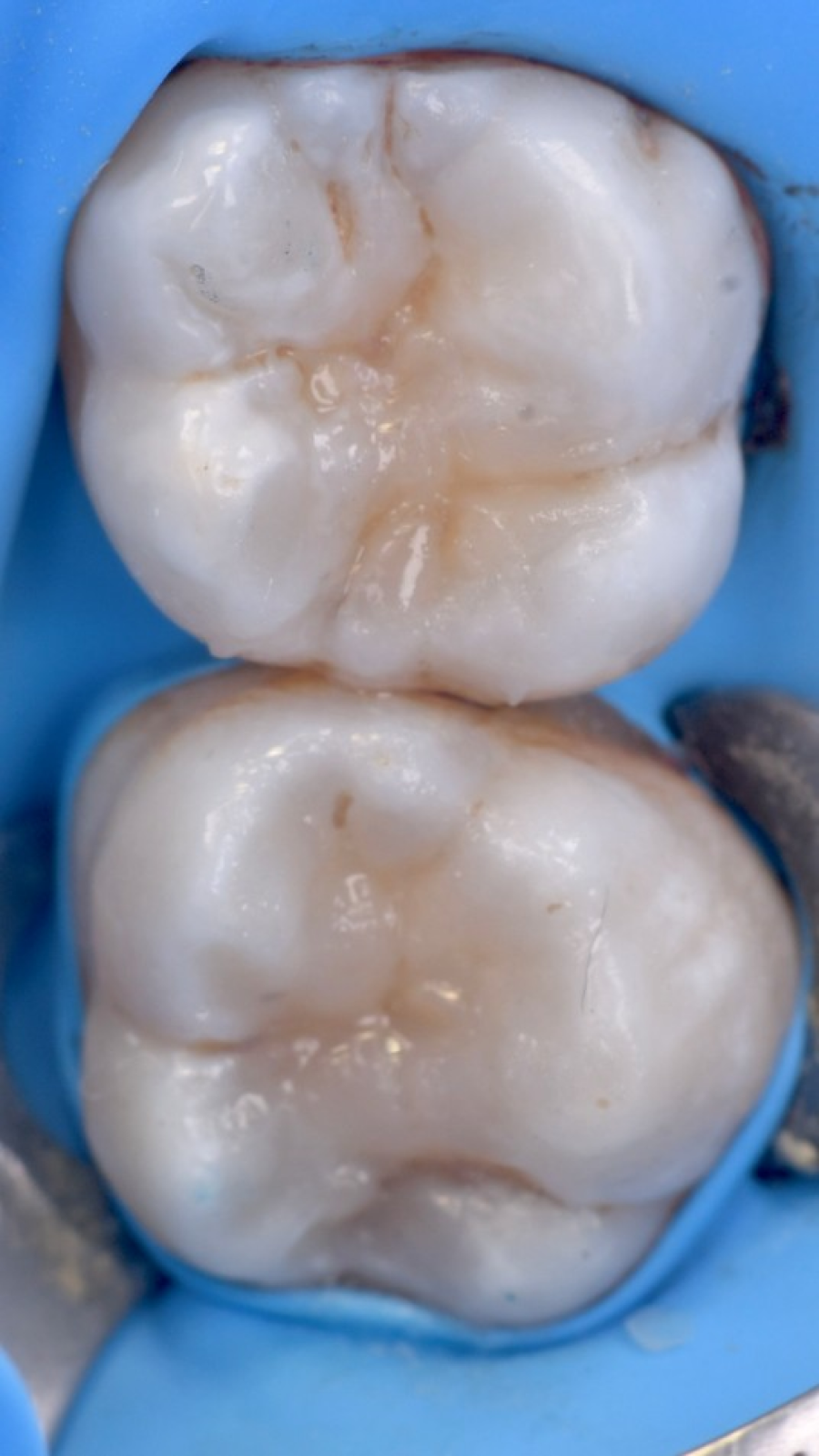 chirurgie implantaire strasbourg chirurgie implantaire strasbourg Gestion des caries : préserver vos dents avant tout Dentiste Orangerie, Strasbourg | Esthétique & Implant