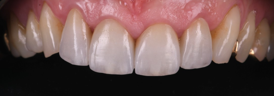 chirurgie osseuse strasbourg Remodelage esthétique des gencives Dentiste Orangerie, Strasbourg | Esthétique & Implant