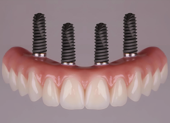 consultation dentaire strasbourg Cas de l’édenté complet : des solutions fixes et confortables Dentiste Orangerie, Strasbourg | Esthétique & Implant