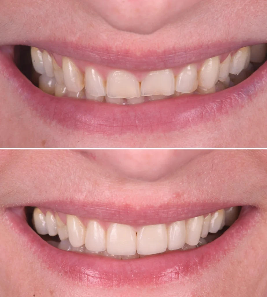 correction malpositions strasbourg Composite stratifié : la précision esthétique au naturel Dentiste Orangerie, Strasbourg | Esthétique & Implant