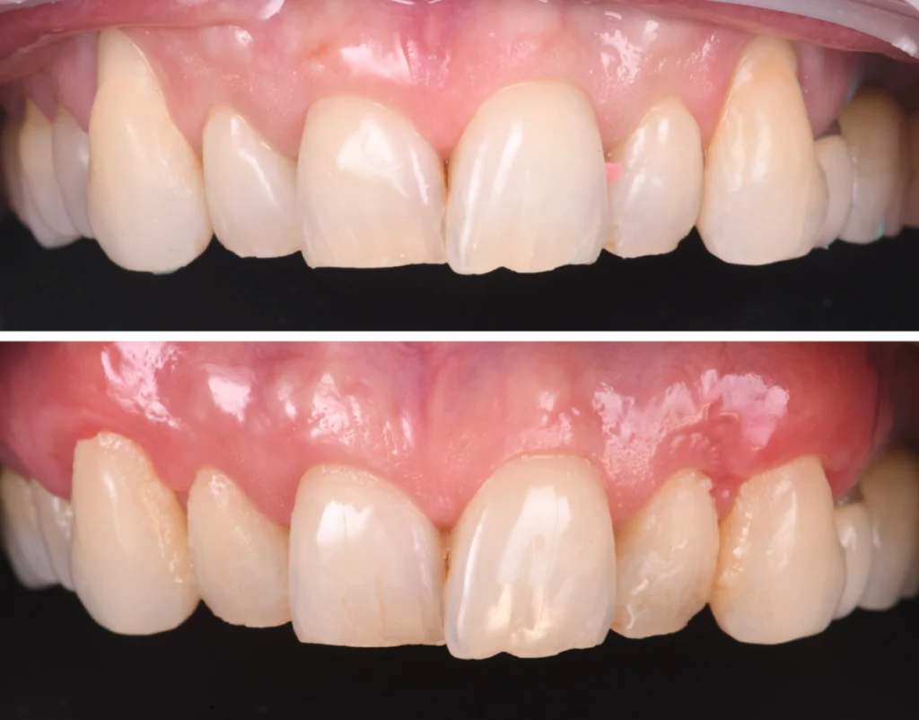 correction morsure strasbourg Greffes de gencives et chirurgie mucogingivale Dentiste Orangerie, Strasbourg | Esthétique & Implant