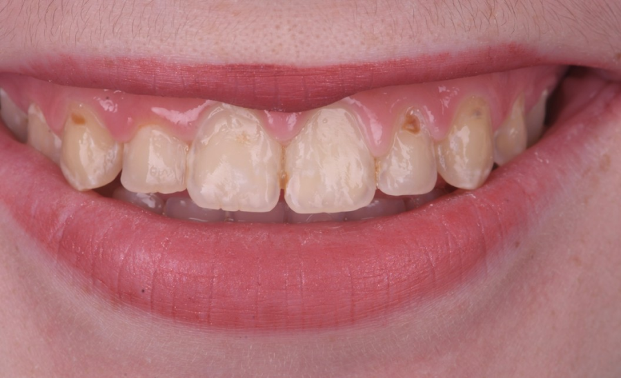 correction sourire strasbourg correction sourire strasbourg Gestion des caries : préserver vos dents avant tout Dentiste Orangerie, Strasbourg | Esthétique & Implant