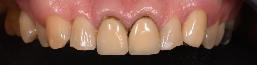 couronnes dentaires esthetique durabilite Couronnes dentaires : allier esthétique et durabilité Dentiste Orangerie, Strasbourg | Esthétique & Implant