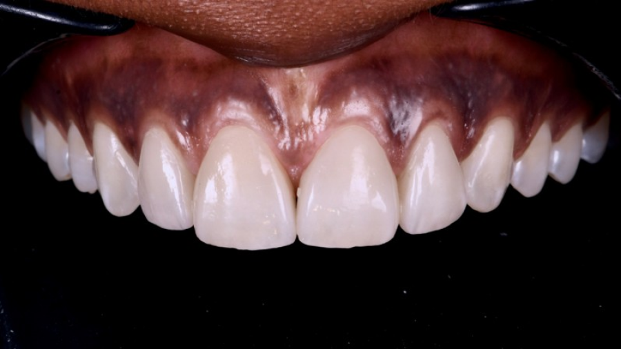 dentiste specialise strasbourg Remodelage esthétique des gencives Dentiste Orangerie, Strasbourg | Esthétique & Implant