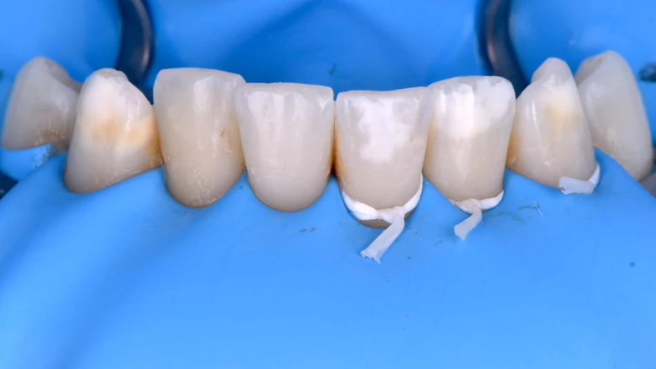 dentiste strasbourg orangerie tache dentaire 1 Traitement des tâches dentaires : un sourire magnifié Dentiste Orangerie, Strasbourg | Esthétique & Implant