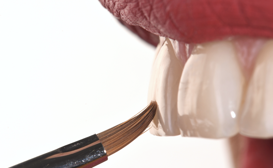 Dentiste Orangerie, Strasbourg | Esthétique & Implant image Planification numérique et chirurgie guidée : précision et sécurité Implantologie : des solutions innovantes pour restaurer votre sourire