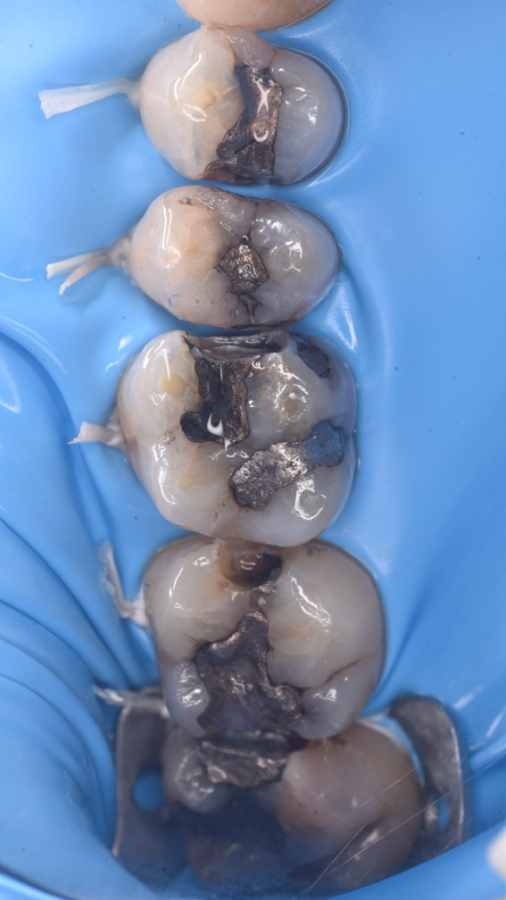esthetique dentaire strasbourg esthetique dentaire strasbourg Remplacement d’anciens soins Dentiste Orangerie, Strasbourg | Esthétique & Implant