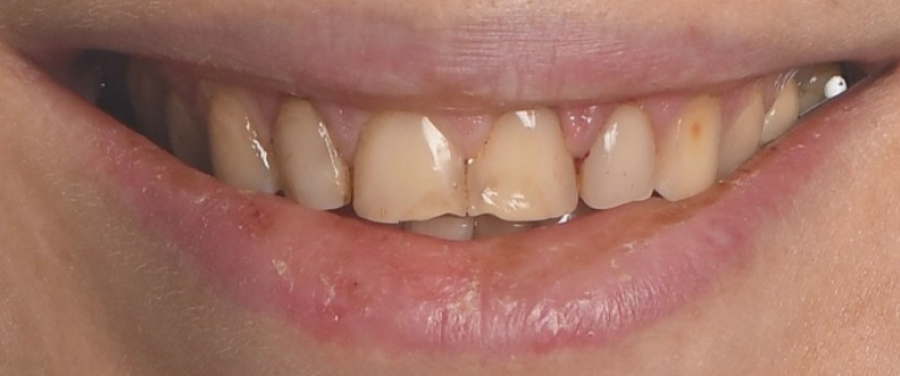 esthetique sourire strasbourg Facettes dentaires : pour un sourire parfait et naturel Dentiste Orangerie, Strasbourg | Esthétique & Implant