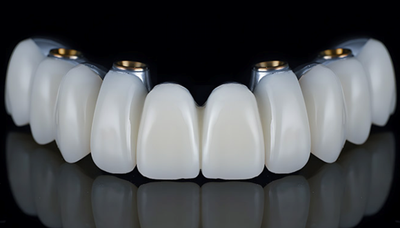 evaluation sourire strasbourg Cas de l’édenté complet : des solutions fixes et confortables Dentiste Orangerie, Strasbourg | Esthétique & Implant