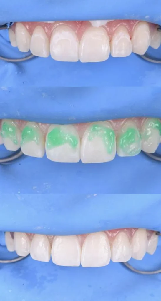 exemple traitement taches dentaires strasbourg 1 Traitement des tâches dentaires : un sourire magnifié Dentiste Orangerie, Strasbourg | Esthétique & Implant