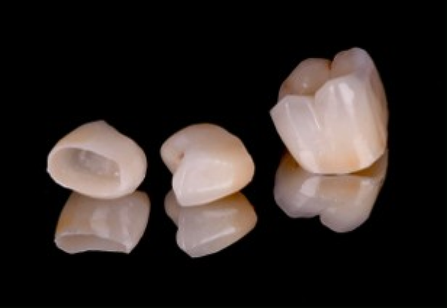 extraction dents strasbourg Couronnes dentaires : allier esthétique et durabilité Dentiste Orangerie, Strasbourg | Esthétique & Implant
