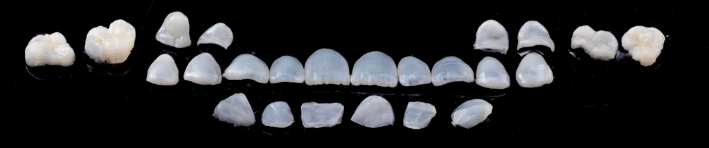 facette ceramique strasbourg 1024x215 Facettes dentaires : pour un sourire parfait et naturel Dentiste Orangerie, Strasbourg | Esthétique & Implant