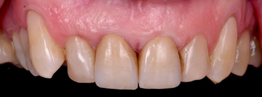 facettes dentaires strasbourg Couronnes dentaires : allier esthétique et durabilité Dentiste Orangerie, Strasbourg | Esthétique & Implant