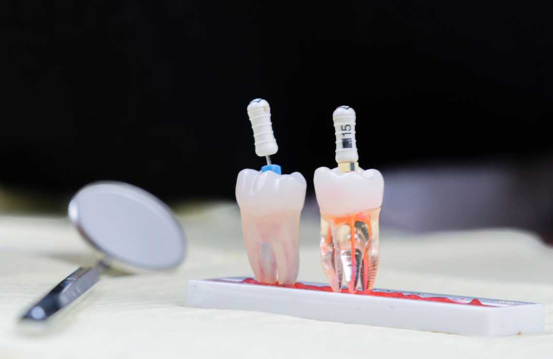 facettes reparation immediate Traitement des fractures Dentiste Orangerie, Strasbourg | Esthétique & Implant