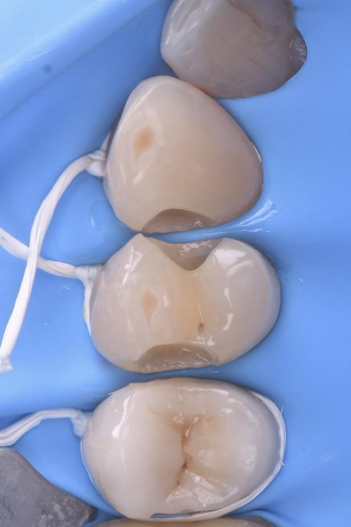 gestion caries 1 gestion caries 1 Gestion des caries : préserver vos dents avant tout Dentiste Orangerie, Strasbourg | Esthétique & Implant