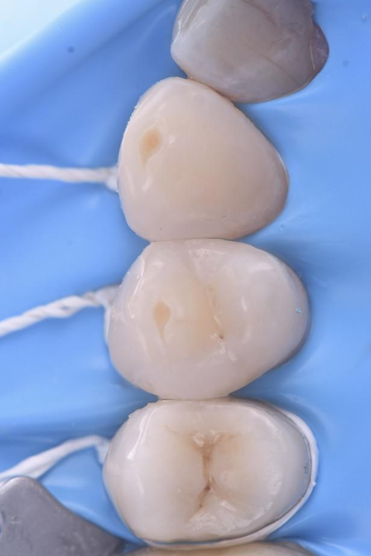 gestion caries dents 1 gestion caries dents 1 Gestion des caries : préserver vos dents avant tout Dentiste Orangerie, Strasbourg | Esthétique & Implant