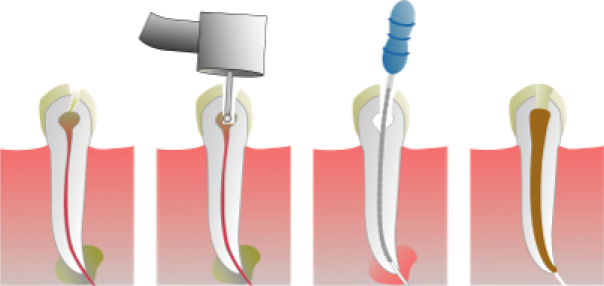 ggouttiere protection dents ggouttiere protection dents Endodontie : sauver vos dents de l’intérieur Dentiste Orangerie, Strasbourg | Esthétique & Implant