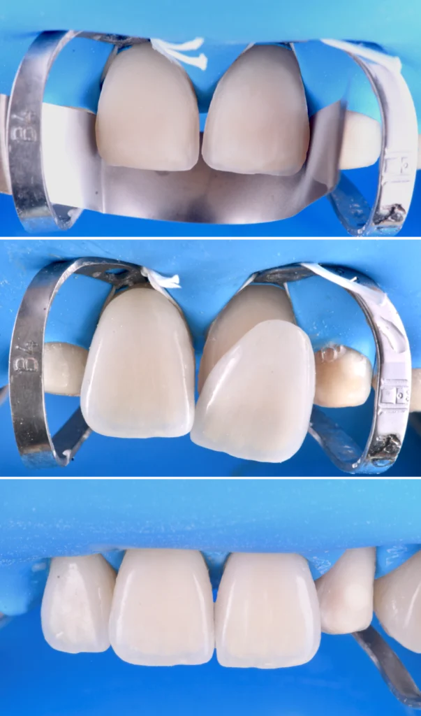 gouttiere blanchiment strasbourg Facettes dentaires : pour un sourire parfait et naturel Dentiste Orangerie, Strasbourg | Esthétique & Implant
