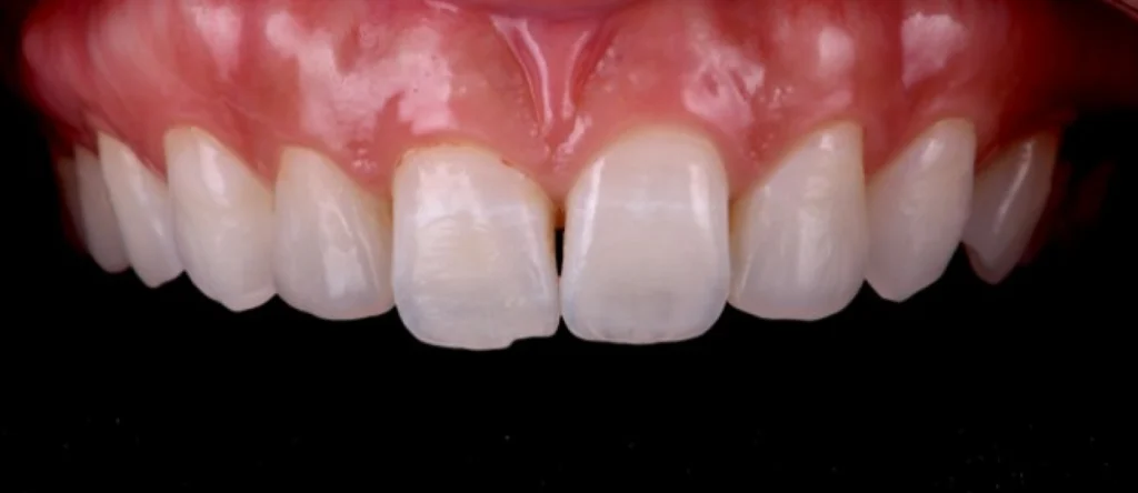 greffe gencive orangerie greffe gencive orangerie Concept de gradient thérapeutique Dentiste Orangerie, Strasbourg | Esthétique & Implant