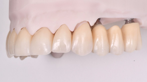 hygiene buccale strasbourg Bridges dentaires Dentiste Orangerie, Strasbourg | Esthétique & Implant