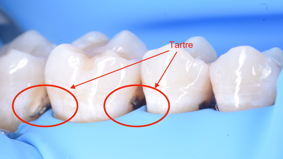 hygiene dentaire strasbourg hygiene dentaire strasbourg Traitement des gencives inflammées et parodontite Dentiste Orangerie, Strasbourg | Esthétique & Implant