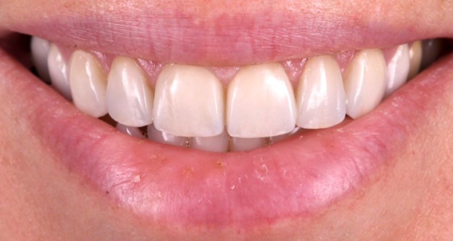 image8 2 Facettes dentaires : pour un sourire parfait et naturel Dentiste Orangerie, Strasbourg | Esthétique & Implant