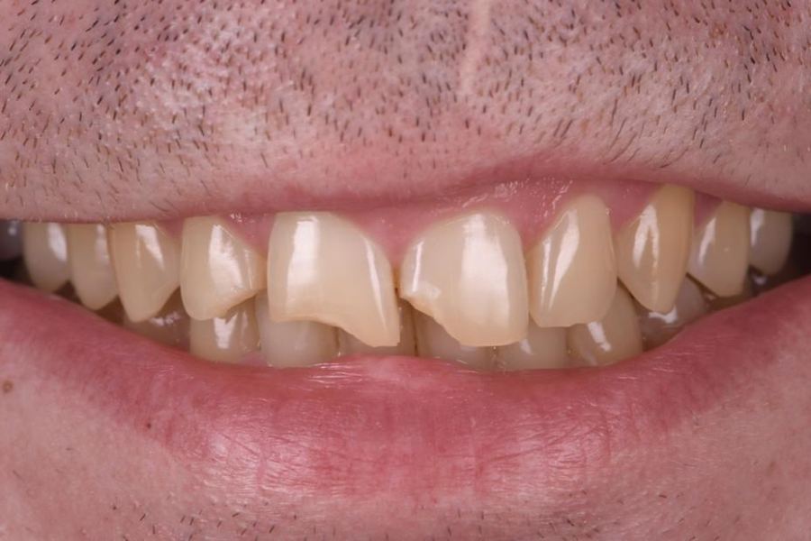 implant dentaire orangerie implant dentaire orangerie Traitement des fractures Dentiste Orangerie, Strasbourg | Esthétique & Implant