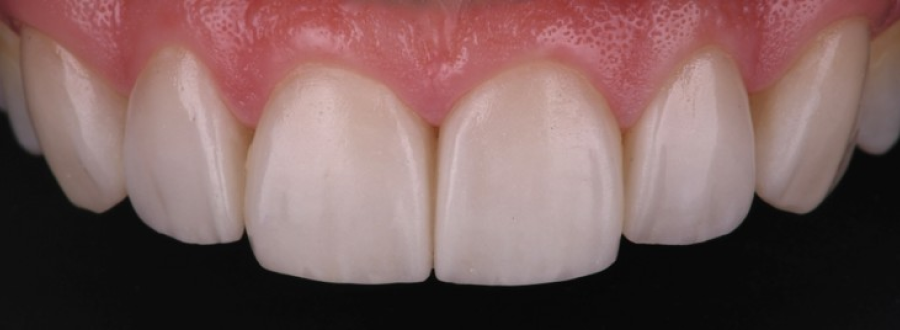 implant haute qualite strasbourg Facettes dentaires : pour un sourire parfait et naturel Dentiste Orangerie, Strasbourg | Esthétique & Implant